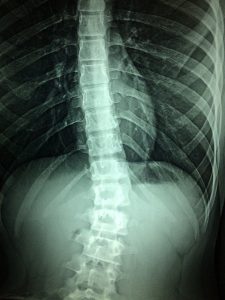How Much Is My Spinal Cord Injury Claim Worth?